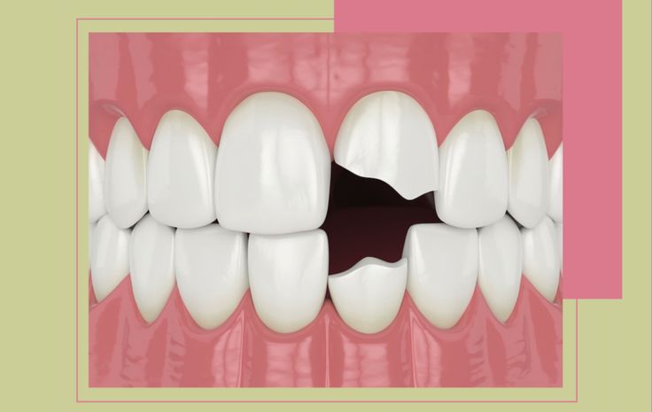 Dente Quebrado: O Que Fazer e Quais as Soluções Mais Eficientes?